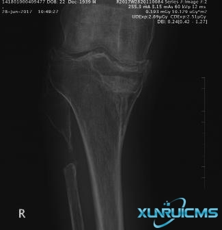 司法鉴定科学研究院对患者腓骨陈旧性骨折合并腓总神经损伤因果关系及伤残等级进行法医临床鉴定案